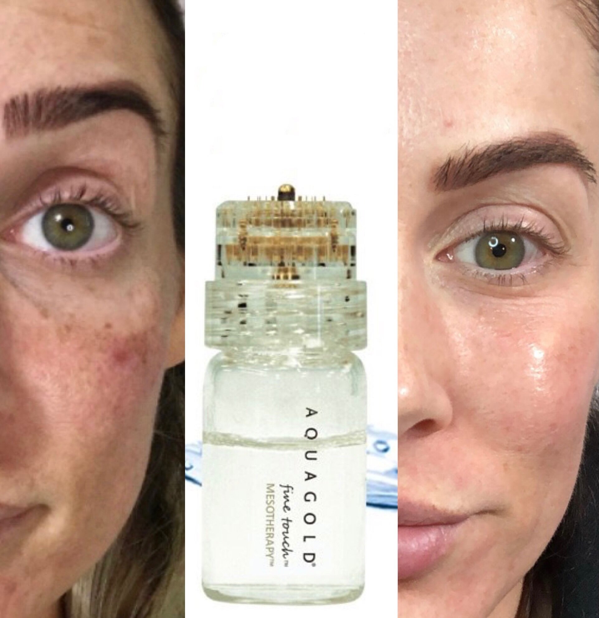 Aquagold Microneedling