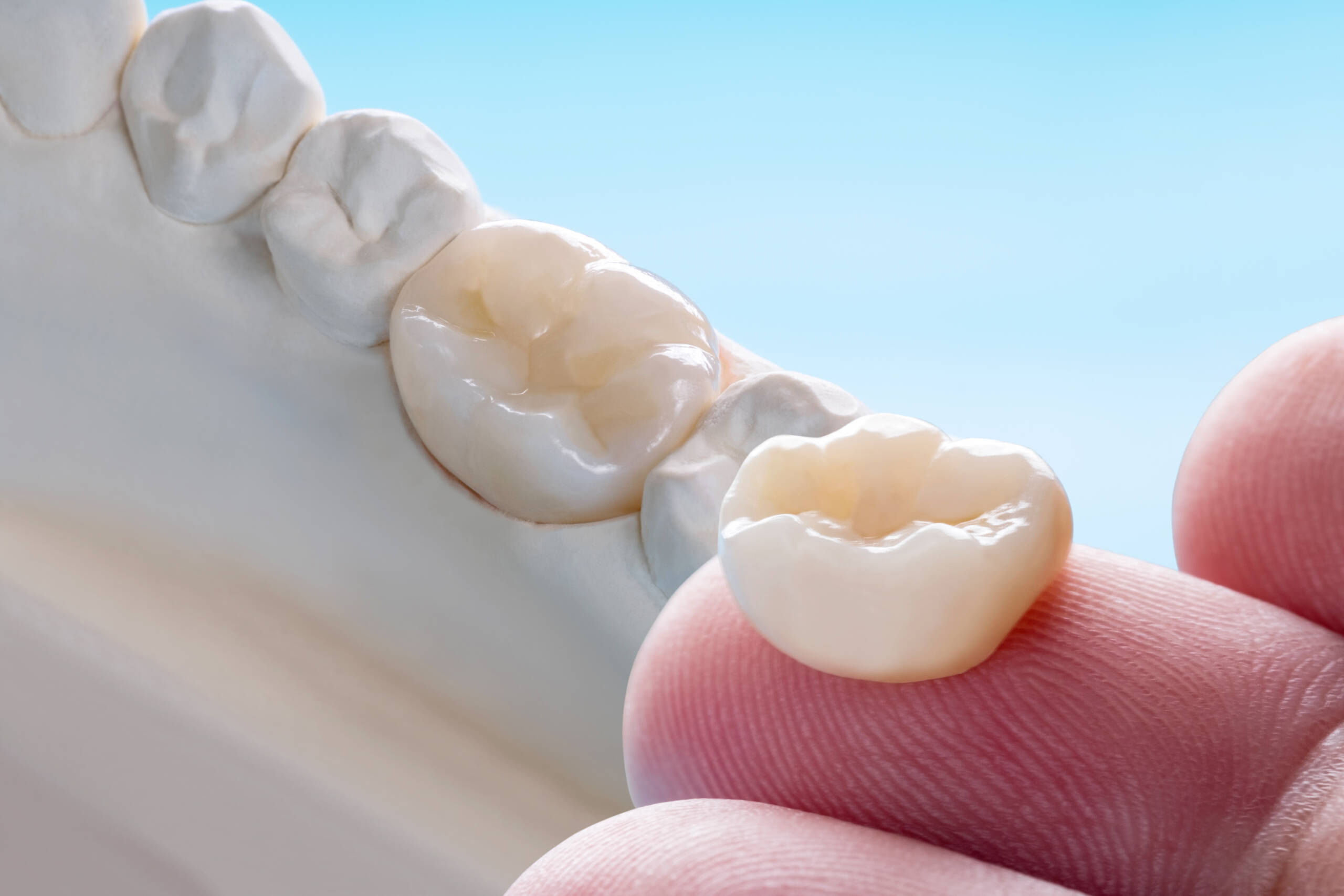 Inlays, Onlays, Fillings