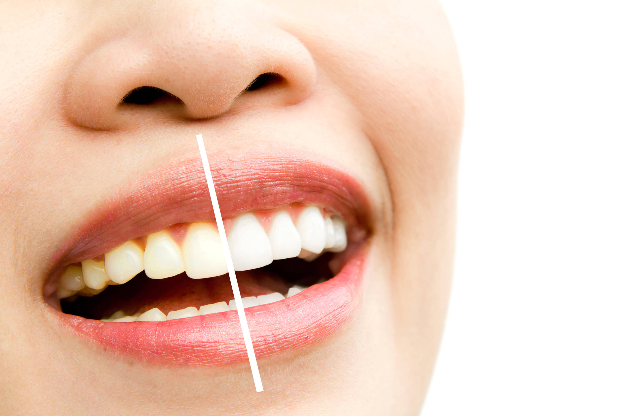Composite Veneers